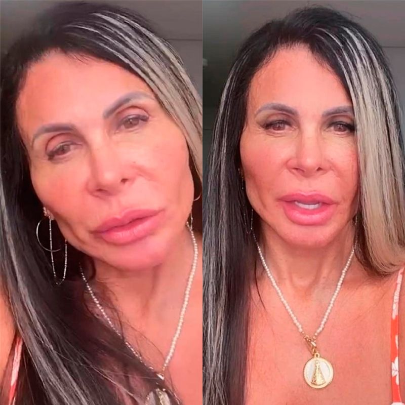 Gretchen mostrou o resultado da harmonização facial nas redes sociais (Foto: Reprodução / Instagram)