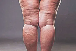 Imagem ilustrativa da imagem Já ouviu falar em síndrome da gordura dolorosa?