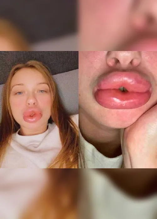Imagem ilustrativa da imagem Mulher fica com lábios deformados após fazer procedimento estético