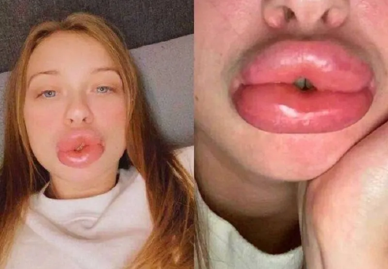Atraída pelo valor baixo, a britânica Louise Smith fez um preenchimento labial com uma esteticista nova no mercado e ficou com lábios três vezes maiores que o normal