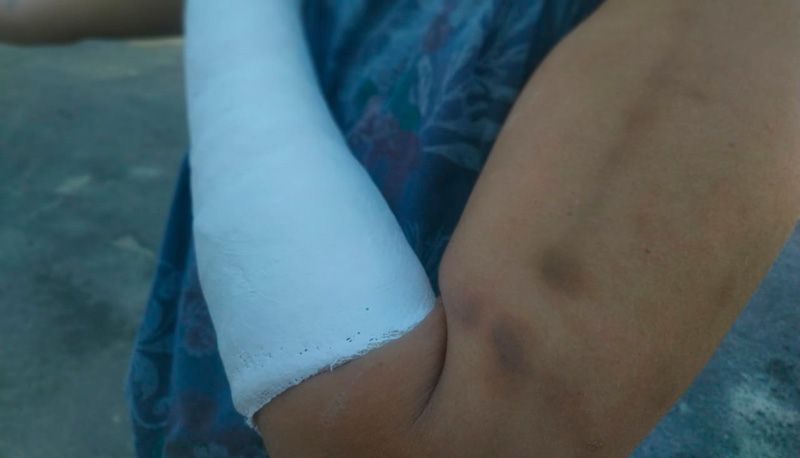 Vítima teve um braço quebrado e ficou com hematomas pelo corpo (Foto: Kananda Natiely / AT)