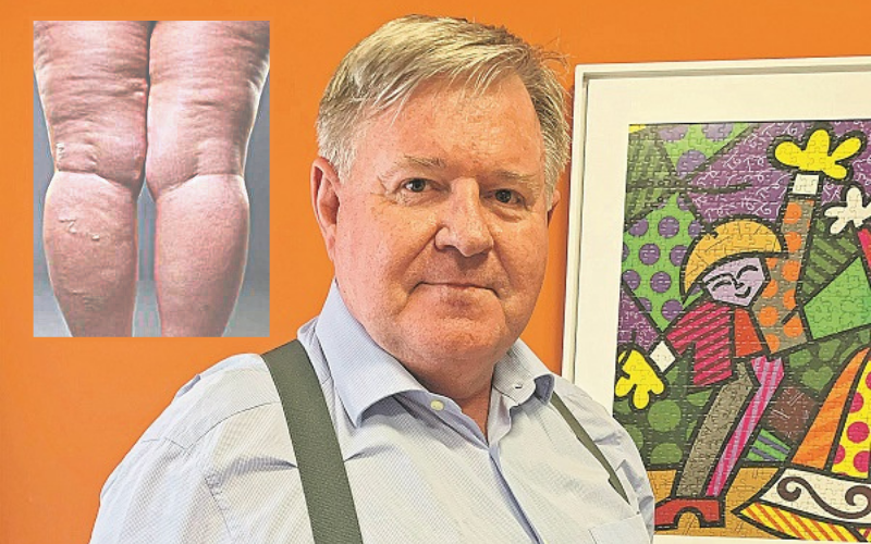 José Corassa diz que o lipedema não tem cura, mas pode ser tratado (Foto: Divulgação)