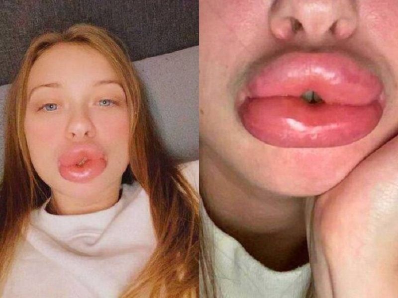 Atraída pelo valor baixo, a britânica Louise Smith fez um preenchimento labial com uma esteticista nova no mercado e ficou com lábios três vezes maiores que o normal (Foto: Reprodução/ Instagram)