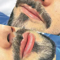 Imagem ilustrativa da imagem Preenchimento labial é tendência entre homens