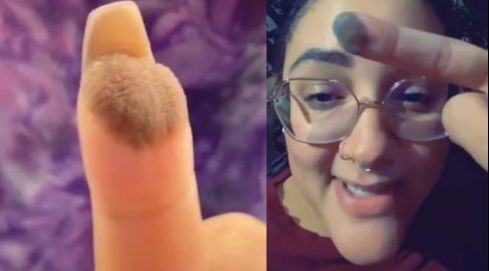 Jovem tem que depilar o dedo após enxerto de pele (Foto: Reprodução/TikTok)
