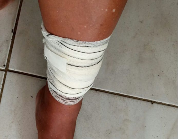 Perna da auxiliar de serviços gerais ficou machucada após a queda (Foto: Acervo pessoal )
