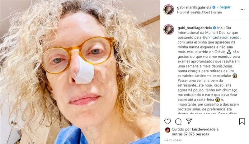 Imagem ilustrativa da imagem Marília Gabriela revela ter feito cirurgia para retirar câncer de pele do nariz