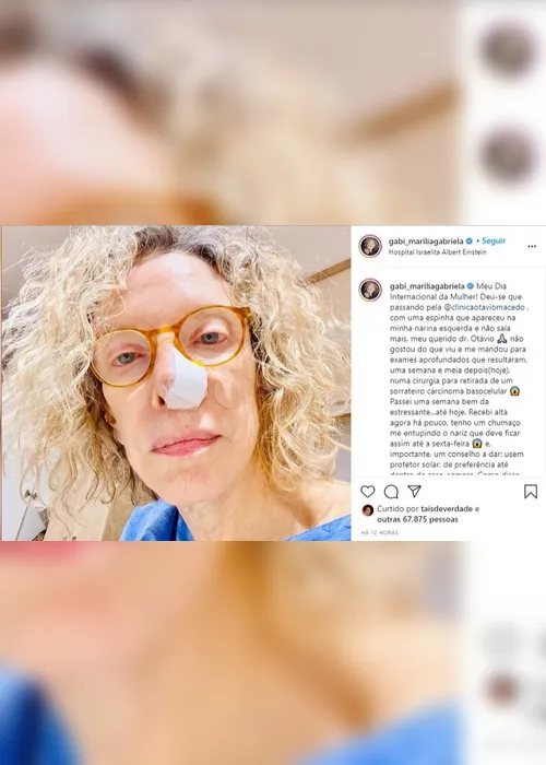 Imagem ilustrativa da imagem Marília Gabriela revela ter feito cirurgia para retirar câncer de pele do nariz