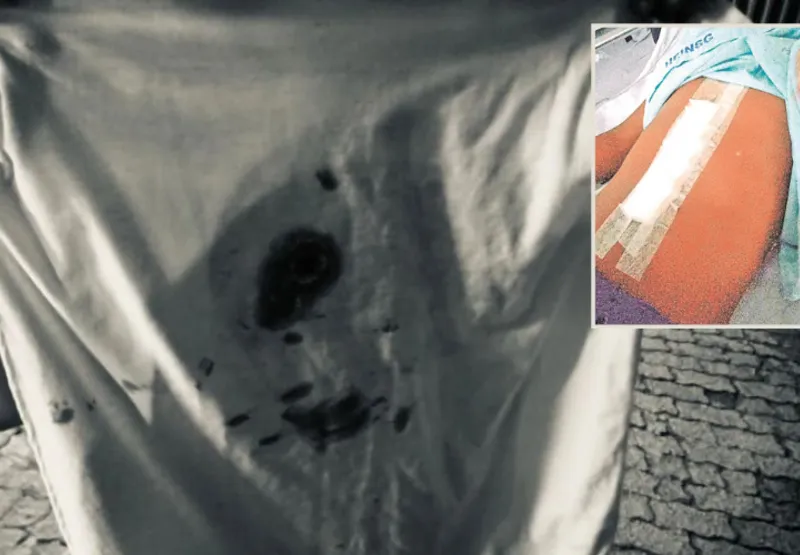 Camisa que menina usava quando foi atingida pela bala. Em destaque, uma foto tirada após a cirurgia da criança
