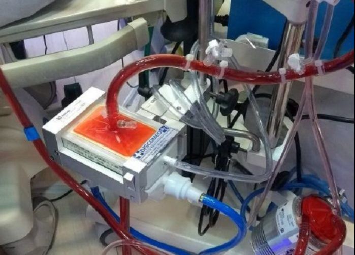 ECMO: Tratamento (Foto: Rozeli Brandão)