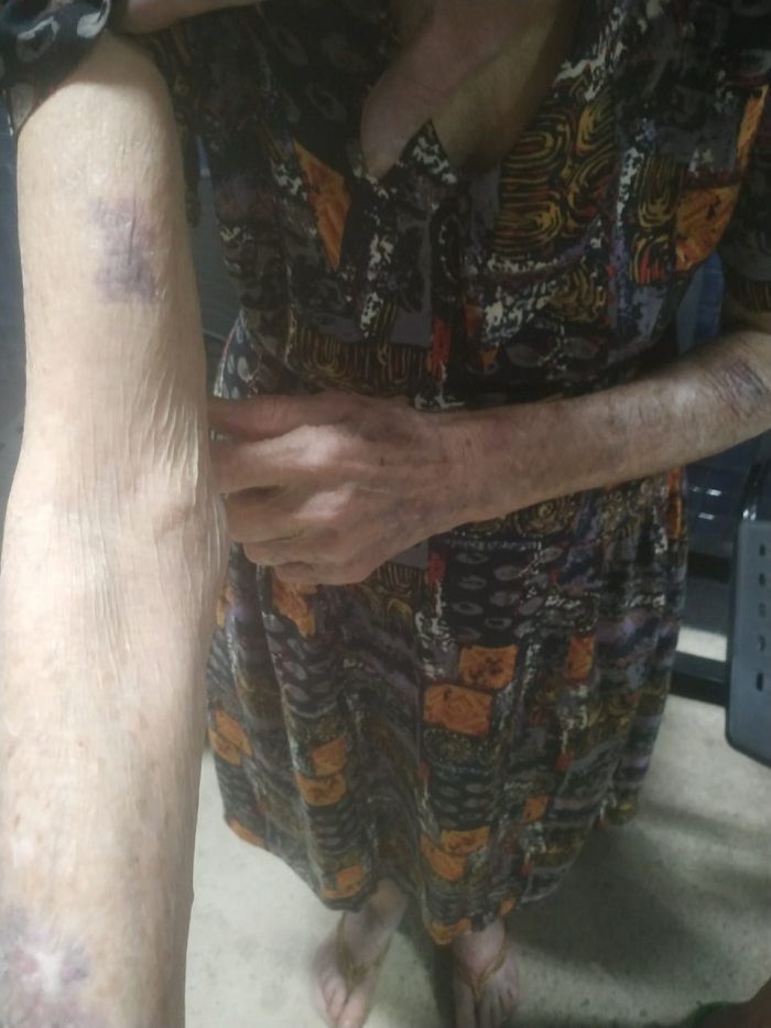 Idosa ficou com hematomas (Foto: Kananda Natielly)