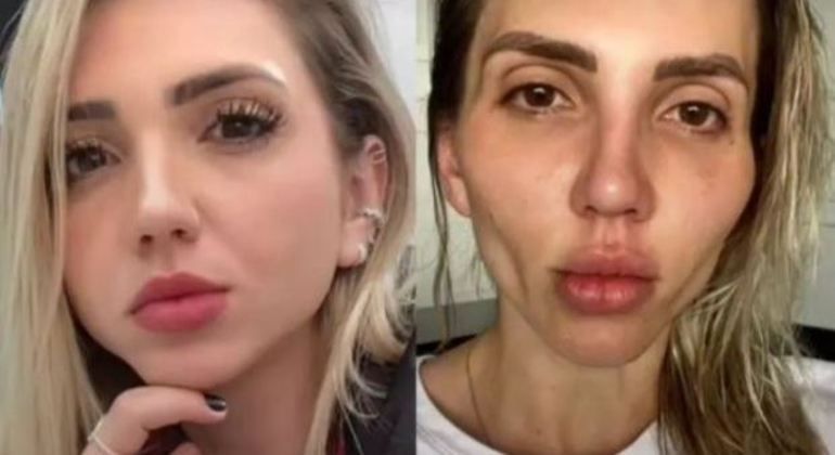 Jéssica antes e depois do procedimento (Foto: Reprodução/ Redes sociais)