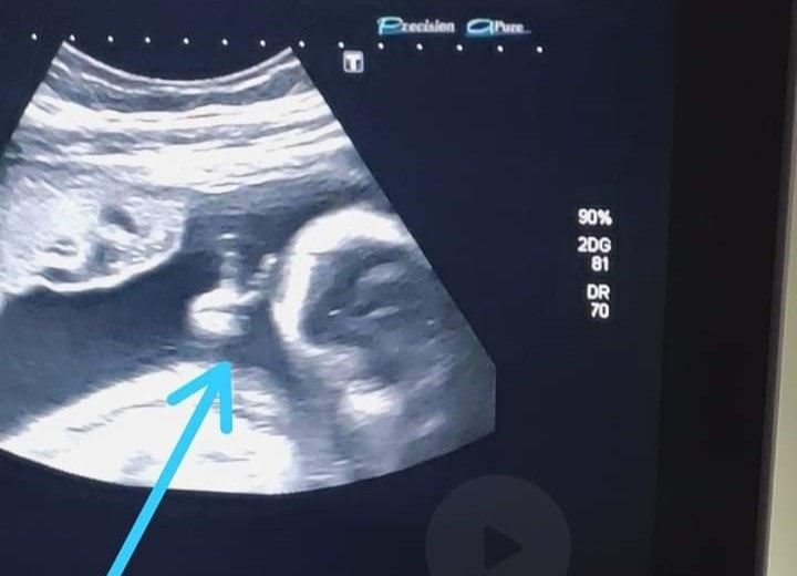 No sexto mês da gestação, bebê faz 'V de vitória' com a mãozinha durante ultrassom (Foto: Reprodução/Facebook)