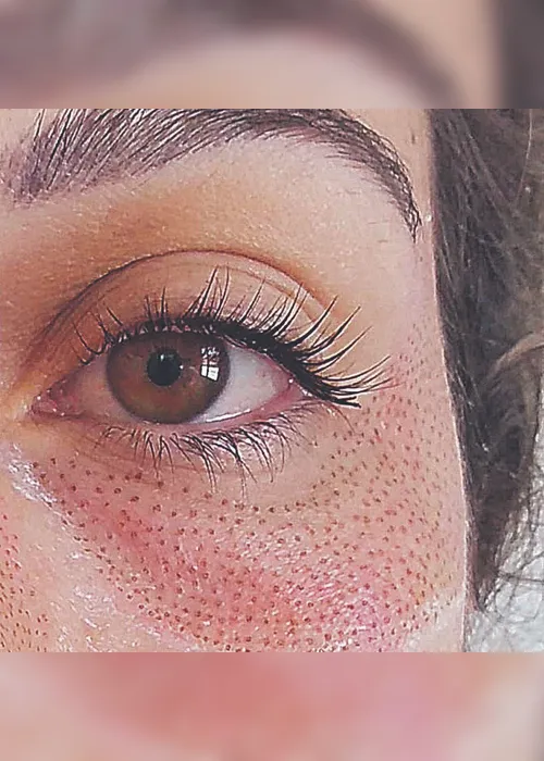 Imagem ilustrativa da imagem Jato de plasma para tratar rugas ao redor dos olhos